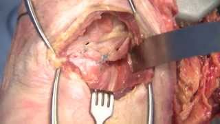 Latarjet Surgical Procedure - Dr. John Tokish