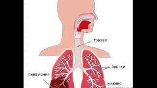 видео Чем отличается воспаление легких от бронхита