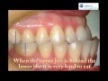 Correcting an Underbite at Orleans Orthodontics