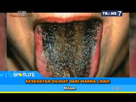 Video: Lidah Hitam: Apa Penyebab Lidah Hitam Dan Cara Menyingkirkannya