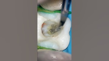 In this video, you can see the process of removing a fiber post. #fiberpost #endodontics