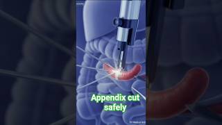 Appendix cut safely #health #anatomy #surgery #appendectomy #leproscopy #viral #appendix cut #