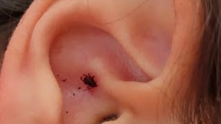 A doctor explains how to properly remove a tick