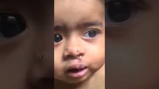 Child's New Smile New Face - Cleft Lip Surgery Result | Dr Mathew PC #shorts