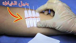 شاهد افضل بديل لخياطة الجروح وداعا للغرز الجراحية_The best alternative to surgical stitches