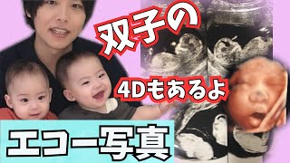エコー写真 双子の4w 35wまでのエコー写真を大公開 4d写真も 貴重 赤ちゃん Ultrasound With 4week Twins Youtube エコー写真 双子の4w 35wまでのエコー写真を大公開 4d写真も 貴重 赤ちゃん Ultrasound With 4week Twins Youtube