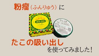 粉瘤（ふんりゅう）に、たこの吸い出しで治った8日間の経過