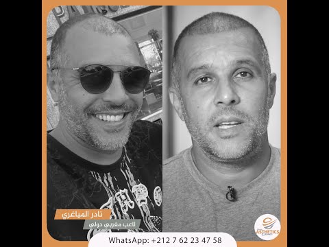 فيديو ناذر المياغري وزراعة الشعر بالمغرب
