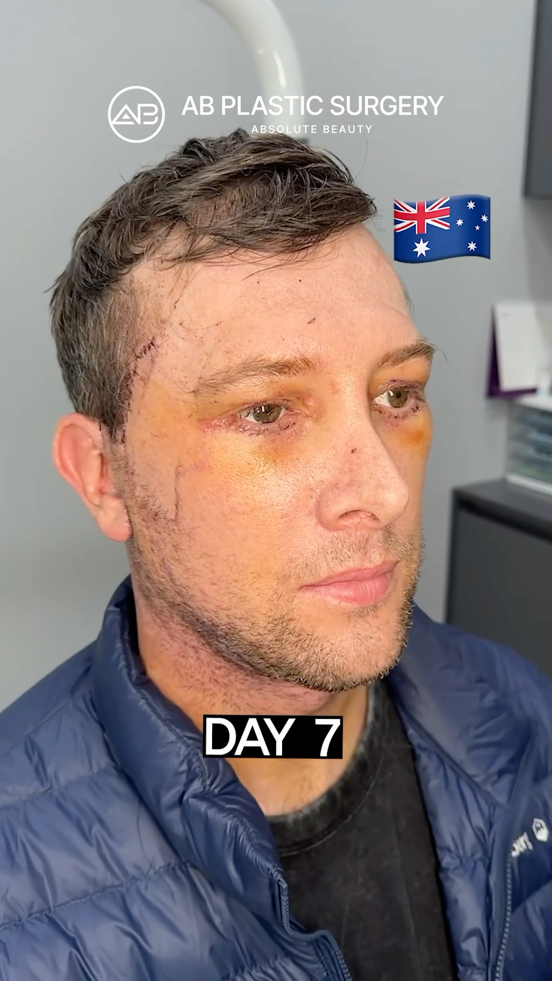 Male Deep Plane Facelift Just 10 Days After #koreanplasticsurgery