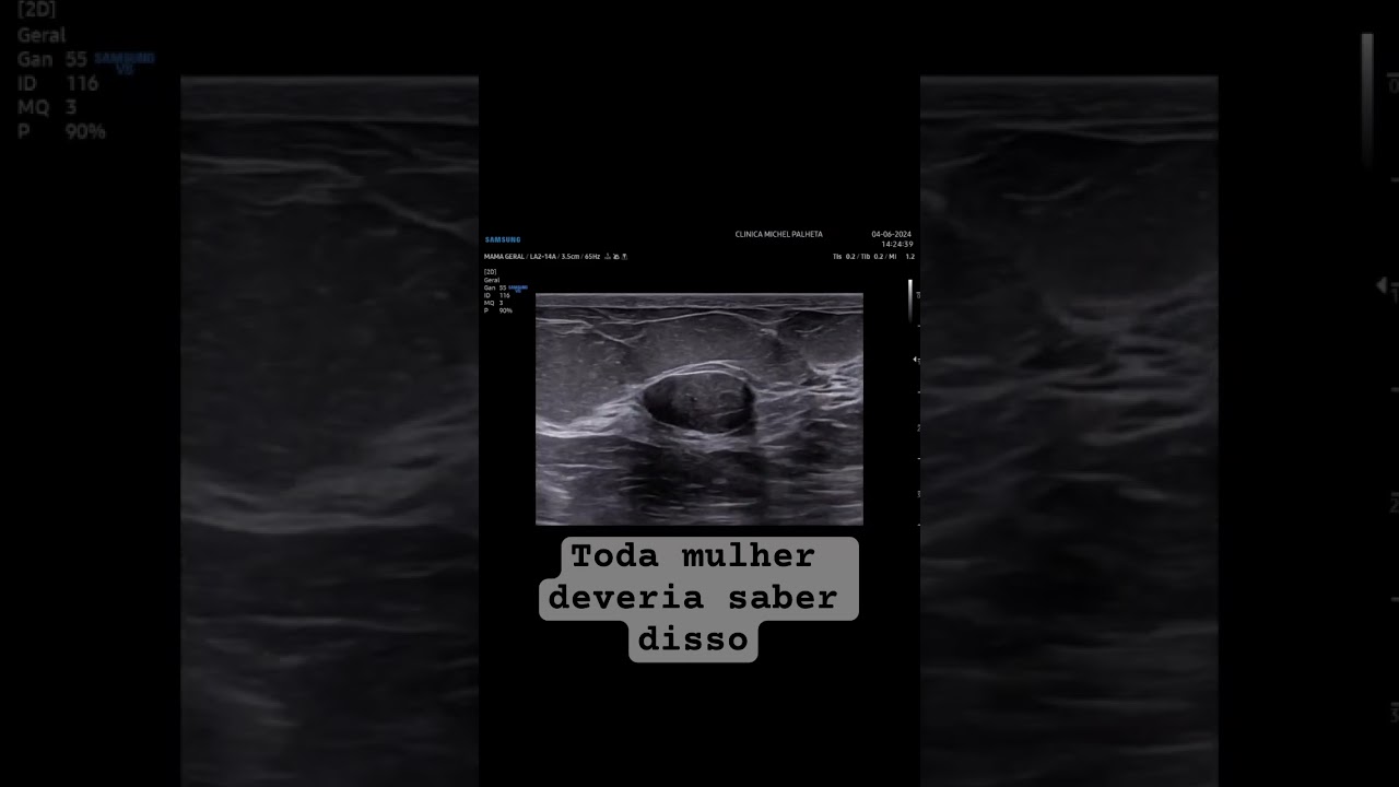 A diferença entre o câncer de mama e o nódulo benigno