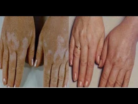 Video: Vitiligo Nasıl Teşhis Edilir: 14 Adım (Resimlerle)