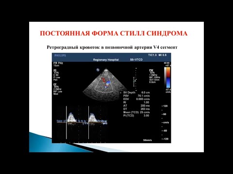 Ультразвуковая диагностика патологии вертебро-базилярной системы