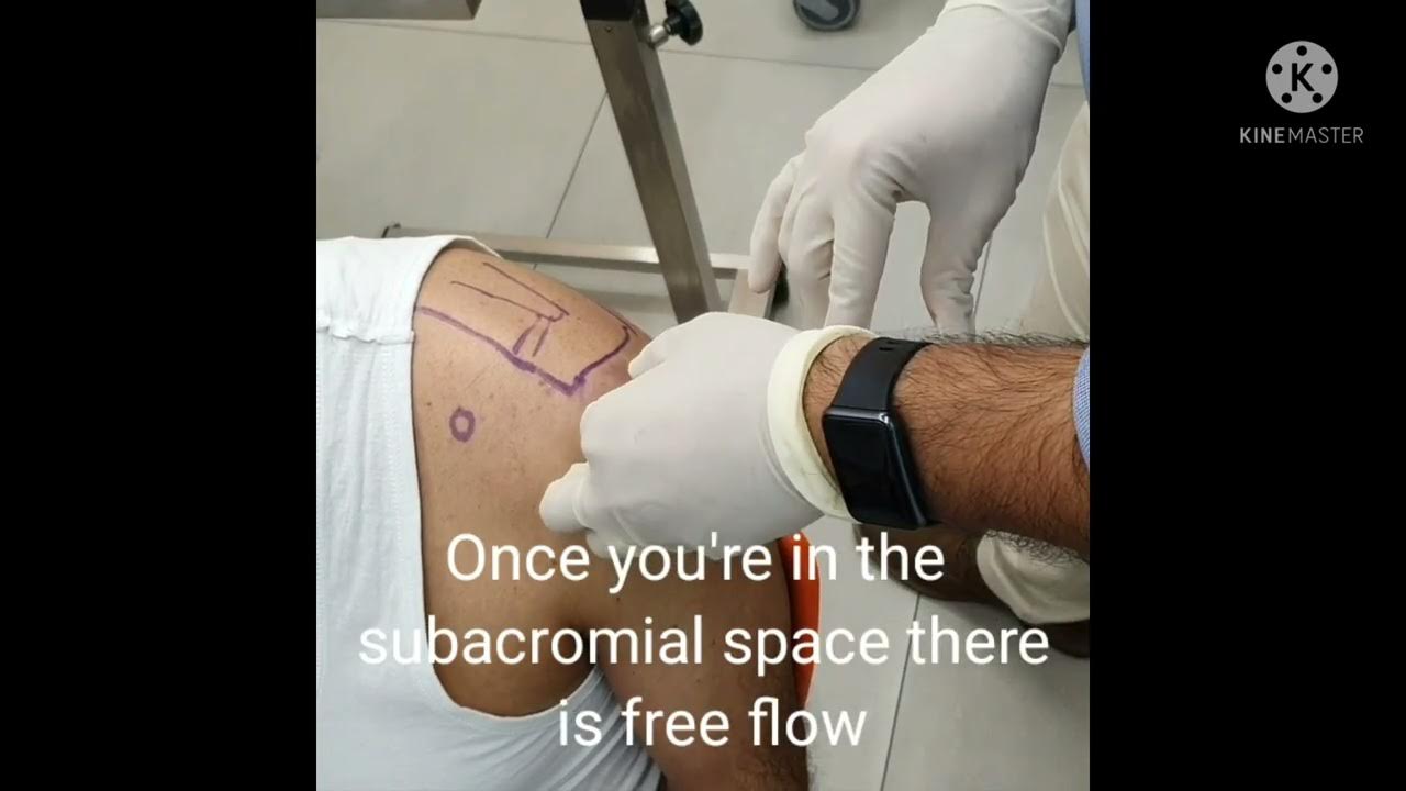 SHOULDER (SUBACROMIAL) STEROID INJECTION TECHNIQUE / DR PRADEEP BALA