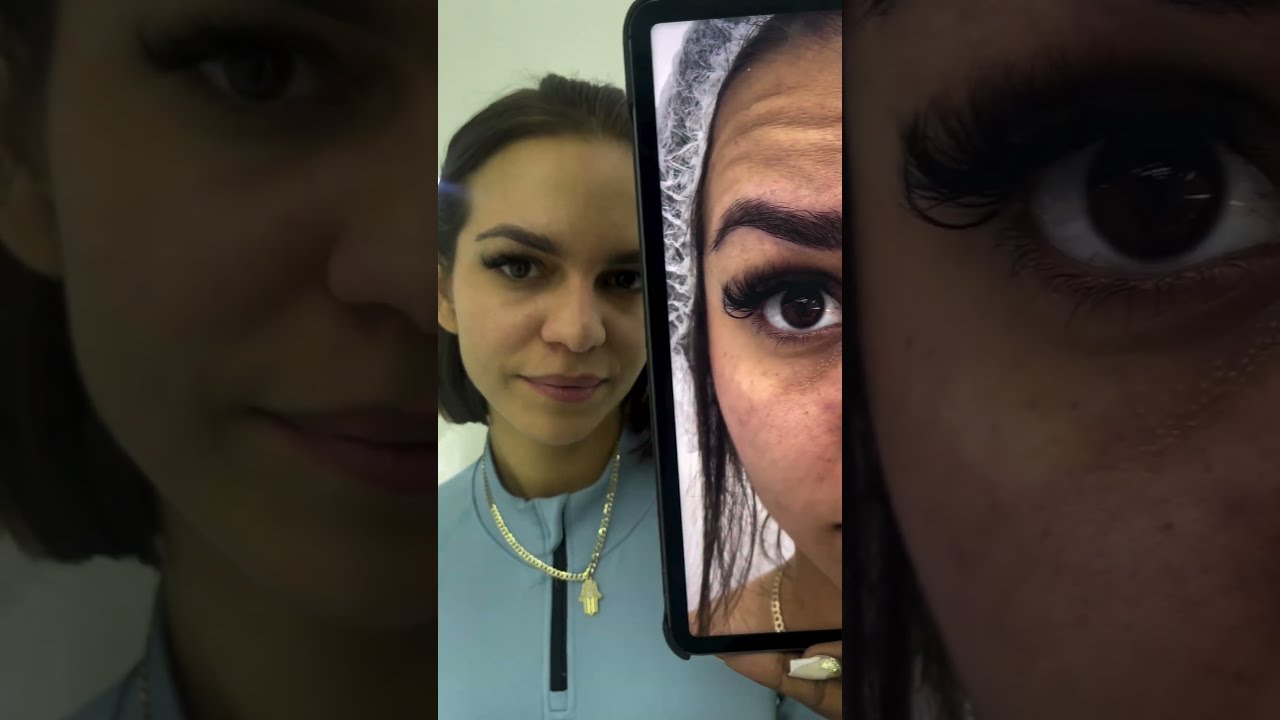 My Ultimate ContourLift facelift experience | Before and After