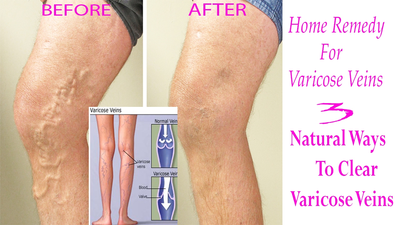 Home Remedy for Varicose Veins 3 Natural Ways To Clear Varicose Veins