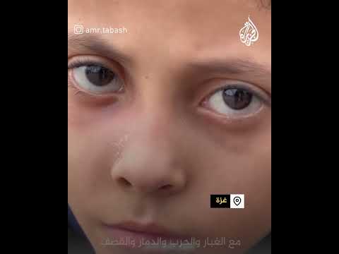 طفلان من غزة يناشدان العلاج بالخارج وسط ظروف إنسانية قاهرة