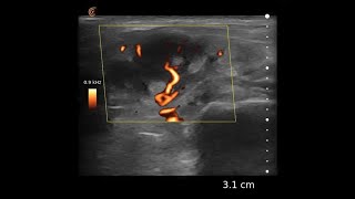 Lymph Node – Ultrasound Image Interpretation screenshot 5