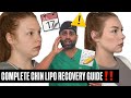 Chin Lipo Recovery Week By Week *what to expect &amp; what to look out for*