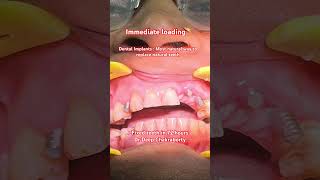 Immediate loading after dental Implants