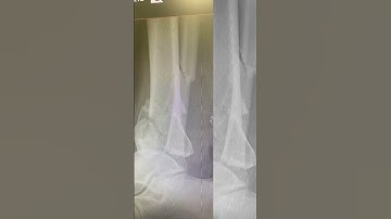 External Fixator X-rays #oureternaleverafter #brokenleg #xray #traumahealing #brokenbone #ouch #heal