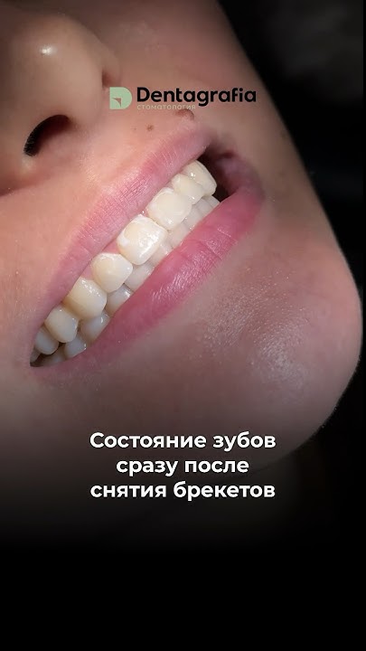 Что стало с зубами за 3 года в брекетах 🤯 #брекеты #элайнеры # ...