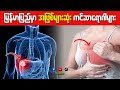**မြန်မာပြည်မှာ အဖြစ်အများဆုံး ကင်ဆာရောဂါများ**