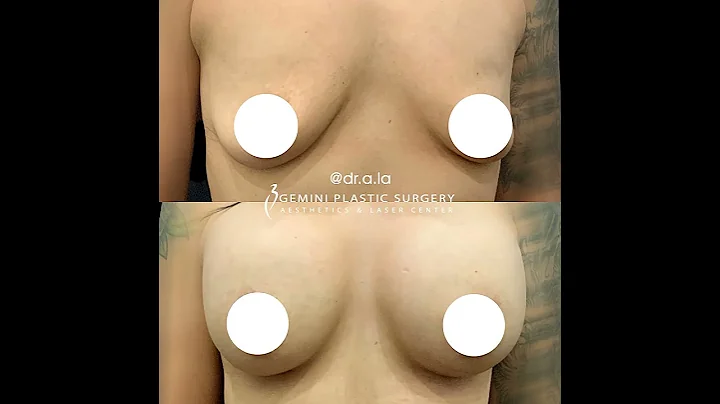 Breast Implants Before & After #038  Dr. Cesar Agu...
