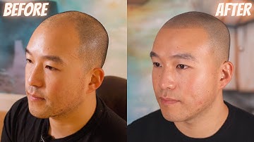 LIFE CHANGING Scalp Micropigmentation Result in New York City