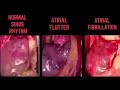 Normal Sinüs Ritmi / Atriyal Flutter / Atriyal Fibrilasyon Kalp Atımı