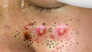 Extreme Blackhead Removal at LNG Skin Care 7216
