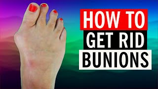 How To Get Rid of Bunions in 2024