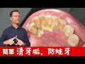 (牙齒3)天然自助清牙垢！怎樣預防蛀牙？柏格醫生 Dr Berg