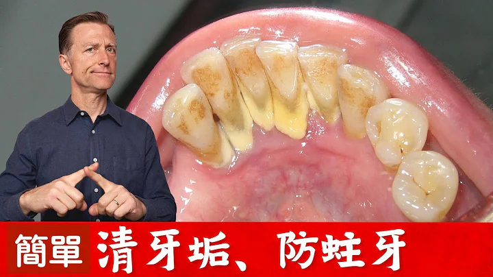 (牙齒3)天然自助清牙垢！怎樣預防蛀牙？柏格醫生 Dr Berg - 天天要聞