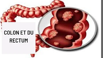 Est-ce que le cancer de l'intestin se soigne ?