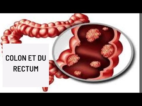 Vidéo: Marqueurs D'ARNm Signature Dans Les Vésicules Extracellulaires Pour Le Diagnostic Précis Du Cancer Colorectal