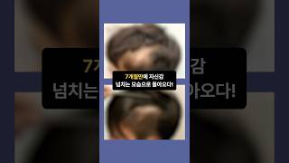 두피의 흉터, 땜방, 재건, 모발이식으로 자신감을 되찾으세요! #흉터 #흉터이식 #모발이식