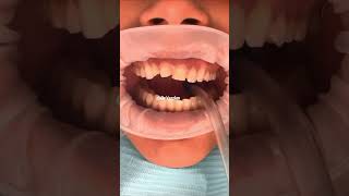 Porcelain veneers before and after | porcelain veneers front teeth | Dr. Yazdan cosmeticdentistry