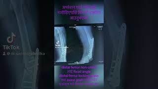 #Distal femur non-union # ORIF with plate and screw plus bonegraft