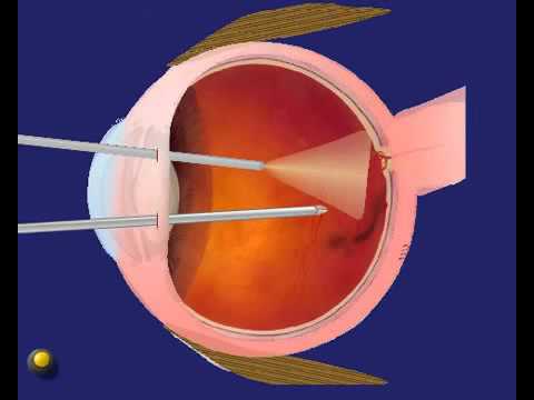 Витреоретинальная хирургия