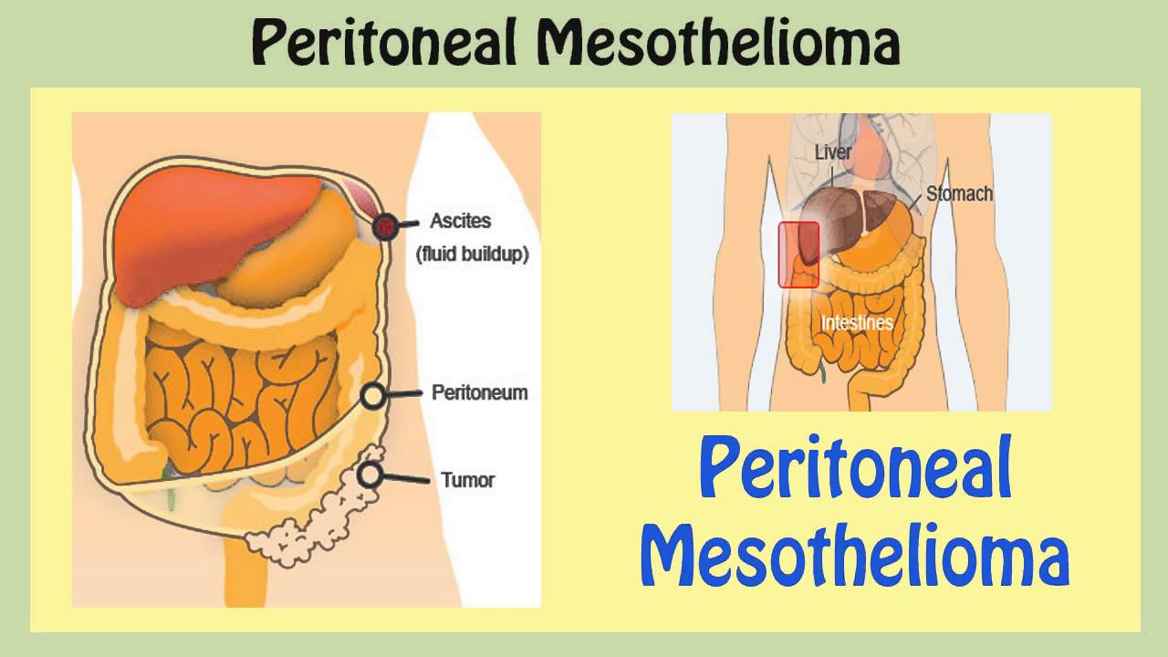 Peritoneal Mesothelioma  Symptoms of Peritoneal Mesothelioma  Online Mesothelioma Reviews 