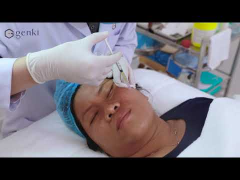 Clip Thực Tế TRỊ NÁM CHÂN SÂU, NÁM LÂU NĂM VỚI PHƯƠNG PHÁP MESOTHERAPY VI ĐIỂM MỚI