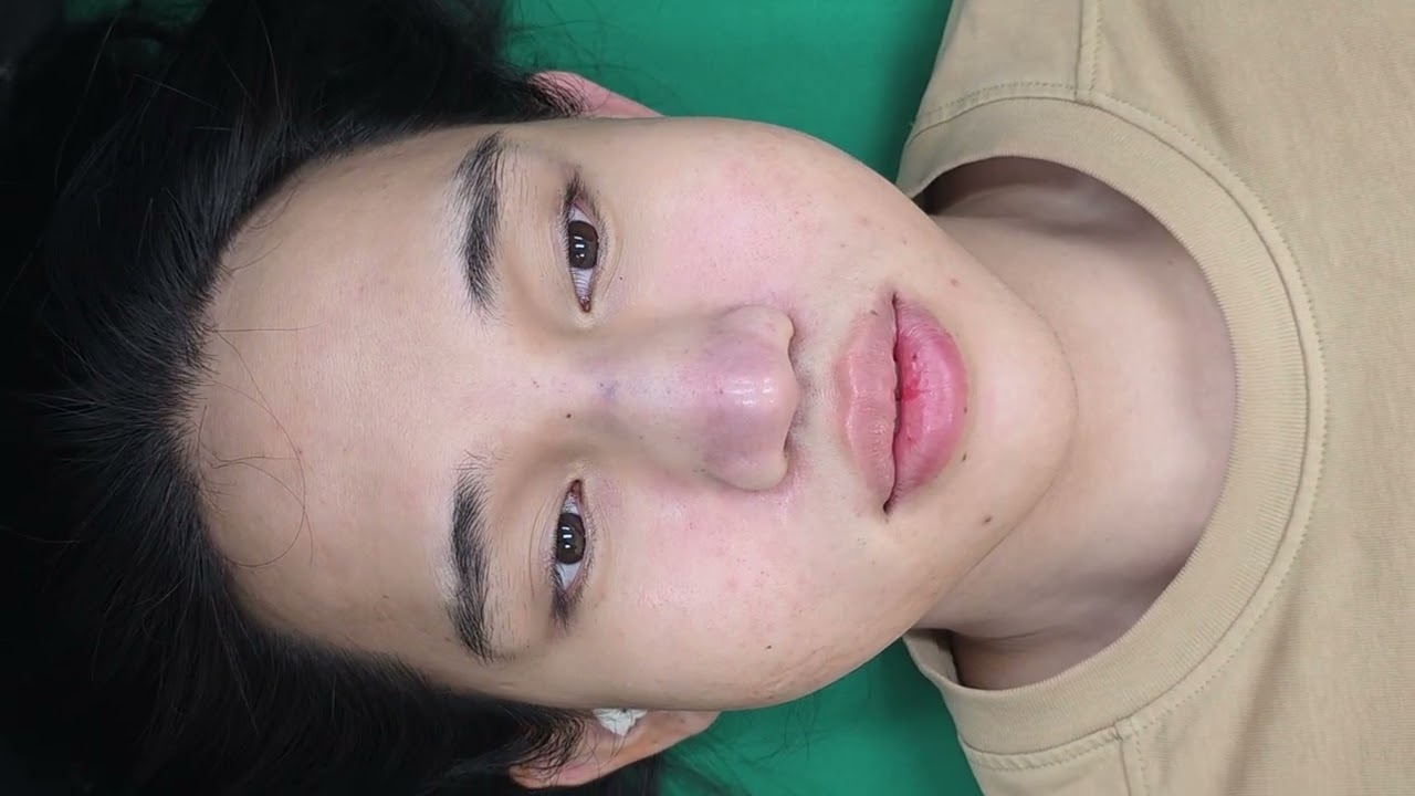 202. Nâng mũi sụn tai DR Vĩnh - Thẩm mỹ Chợ rẫy 0905388576