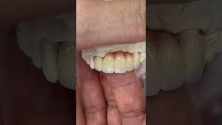 5-Unit Anterior Bridge with Pink Porcelain