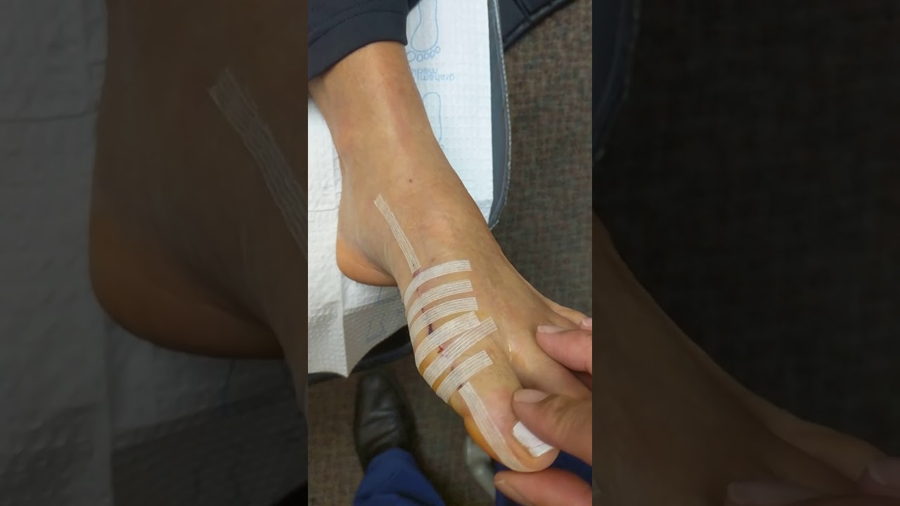 BUNION SURGERY (consultation w/ patient 6 days postop) YouTube