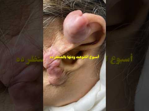 بنت عملت بيرسينج فى غضاريف الودن وبعد فترة ظهر المنظر دا  صحة اكسبلور  طب