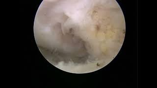 Artroskopik Eklem Faresi (loose body)Eksizyonu