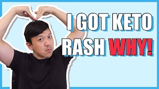 Cure For The Keto Rash Treatment