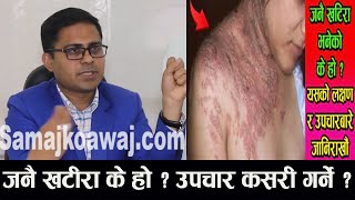 जनैखटिरा आउदा घरेलु उपचारमा समय बिताउनु खतारा हुनसक्छ know about herpes zoster l Dr.kamalRaj Dhital