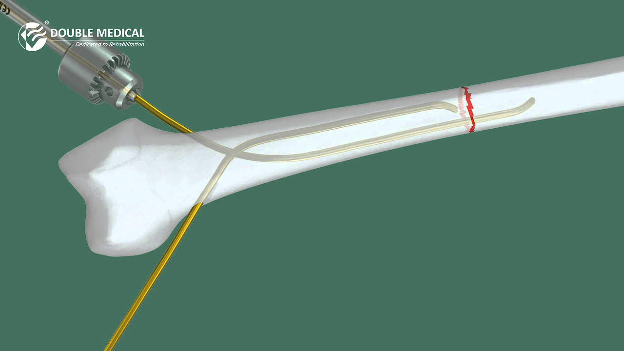 Interlocking Nail System, Thickness: Universal, Intramoleculary Nails at Rs  211 in Vadodara