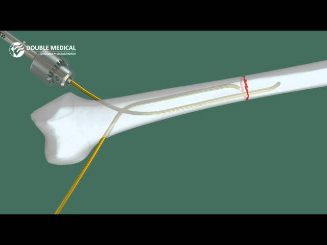 Efficacy of the “Eiffel tower” double titanium elastic nailing in combined  management of congenital pseudarthrosis of the tibia: preliminary outcomes  of 17 cases with review of literature | BMC Musculoskeletal Disorders |  Full Text